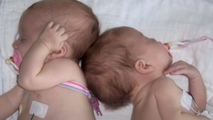 Birth, Girls, Twin, Health, Story, Mother,
