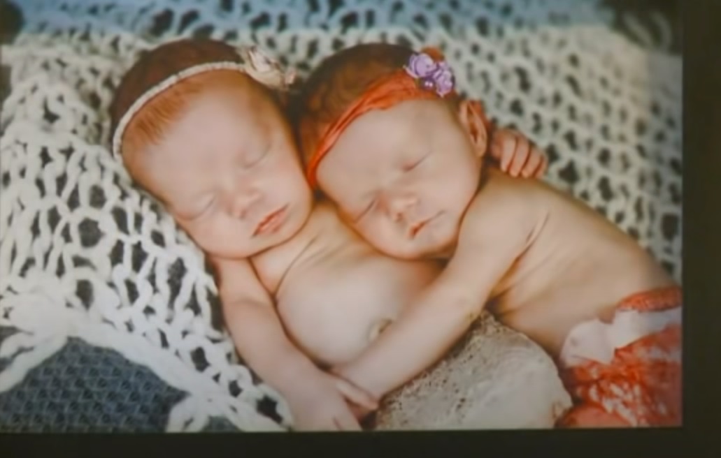 Twins, Born, birth, miracle, babies, Parents, amazing, story,