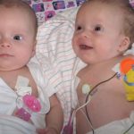 Twin baby Girls fights for life